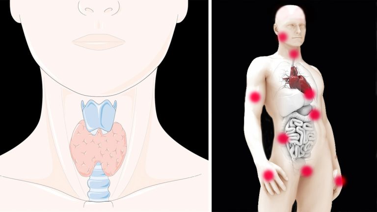 sintomi della tiroide