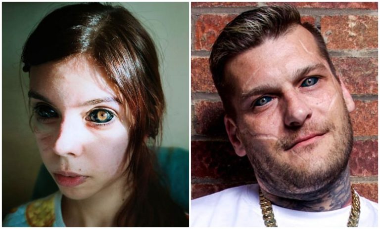 Tatuaggio negli occhi per emulare Popek: ragazza perde la vista